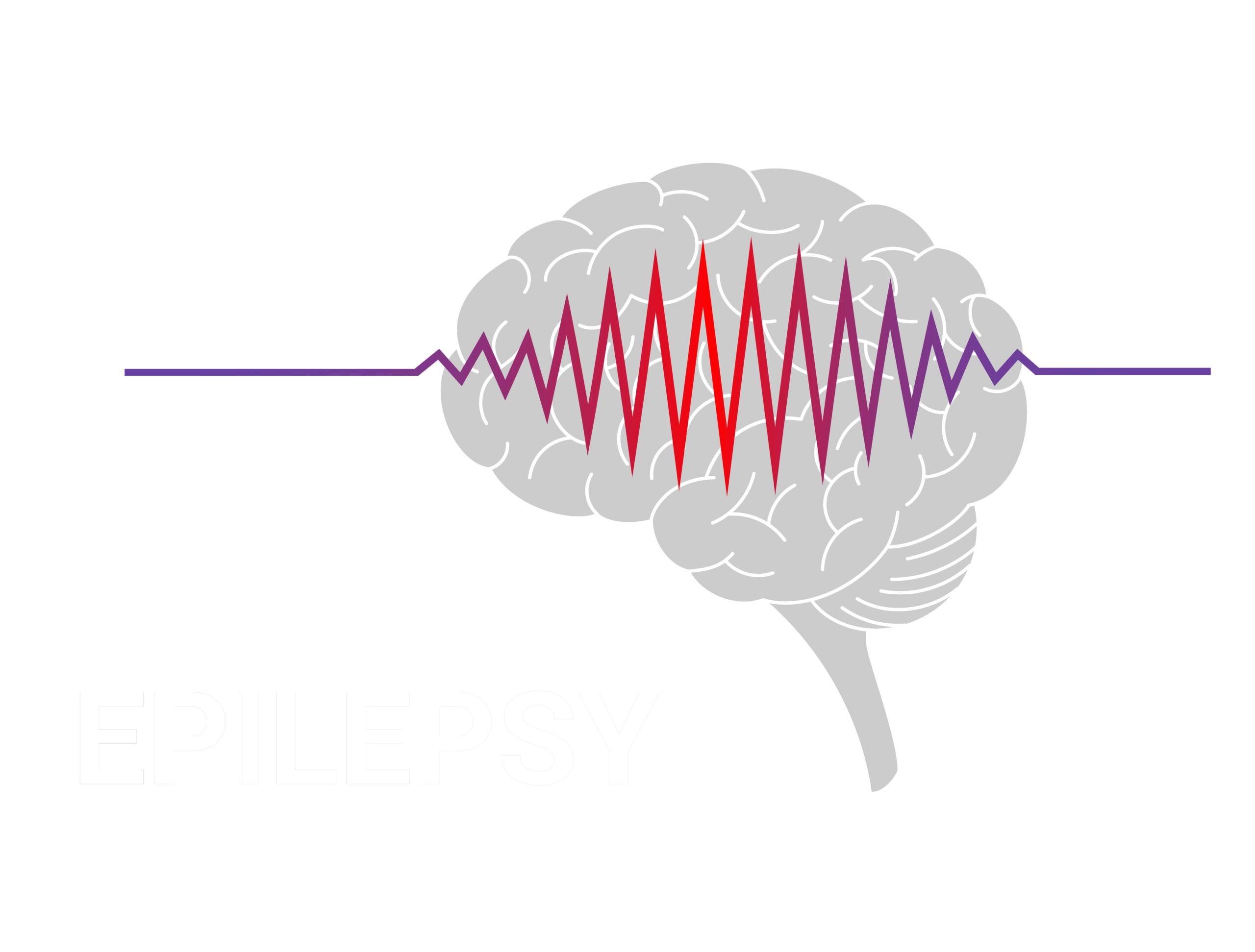 epilepsy brain