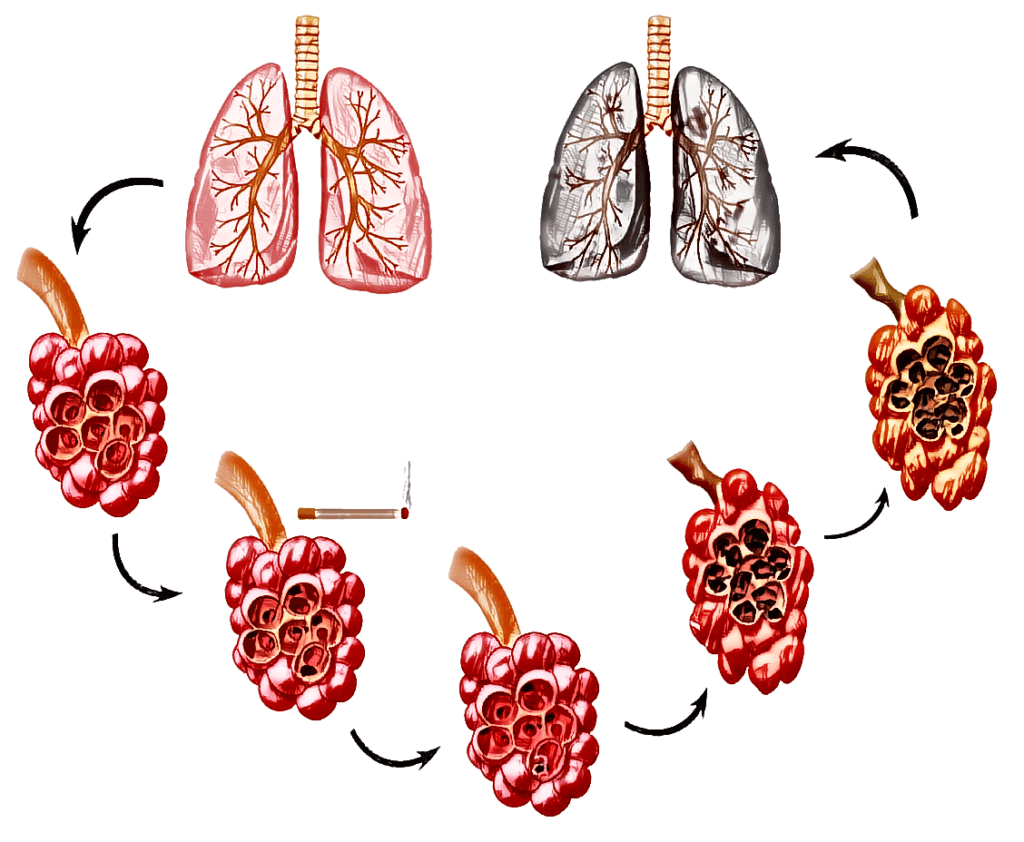 Pulmonary history ⋆ Saint-Bernard Academy